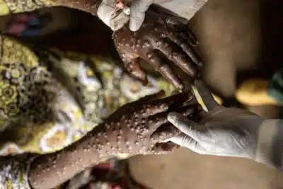 Karanrhada (Congo, The Democratic Republic Of The), 03/09/2024.- A mpox patient receives treatment at the Kavumu hospital in Karanrhada, Kamavu, South Kivu province, Democratic Republic of Congo, 03 September 2024. According to UNICEF, the Democratic Republic of Congo reports the highest number of cases, with over 18,000 suspected infections and 629 fatalities, 463 of them children. The World Health Organization (WHO) director-general on 14 August declared the ongoing outbreaks of mpox in Congo and elsewhere in Africa a Public Health Emergency of International Concern (PHEIC). Mpox causes fever, rash, and lesions all over the body, severe headaches, and fatigue. (Niza) EFE/EPA/MICHAEL LUNANGA