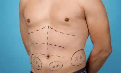 Peito grande em homens: causas, desconfortos e quando a cirurgia é recomendada Peito grande em homens: causas, desconfortos e quando a cirurgia é recomendada