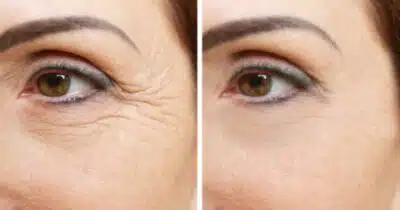 Pele de seda e juventude: Receita caseira com 2 ingredientes elimina manchas e rugas! Pele de seda e juventude: Receita caseira com 2 ingredientes elimina manchas e rugas!