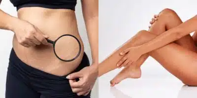 Mulheres: Dicas para disfarçar estrias no verão e ter pele radiante!