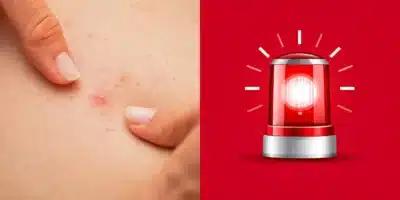 Pelo Preso na Pele: Causas, Prevenção e Como Remover Definitivamente