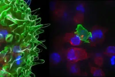 Inovação Chinesa: Células T “Revolucionadas” Prometem Combate Surpreendente ao Câncer