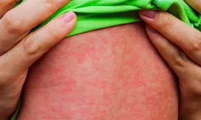 Sarampo volta a assolar São Paulo: alerta e reforço na campanha de vacinação!